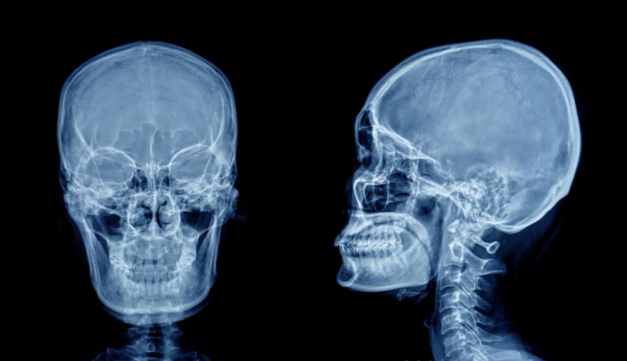 Сотрясение кости. Рентгенограмма черепа норма. Кости черепа рентген норма.